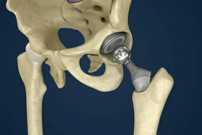 prototypes or medical implant prototypes or medical implant