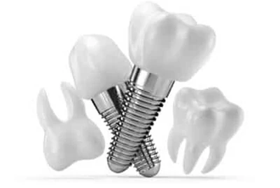 Titanium Alloys Titanium Alloys