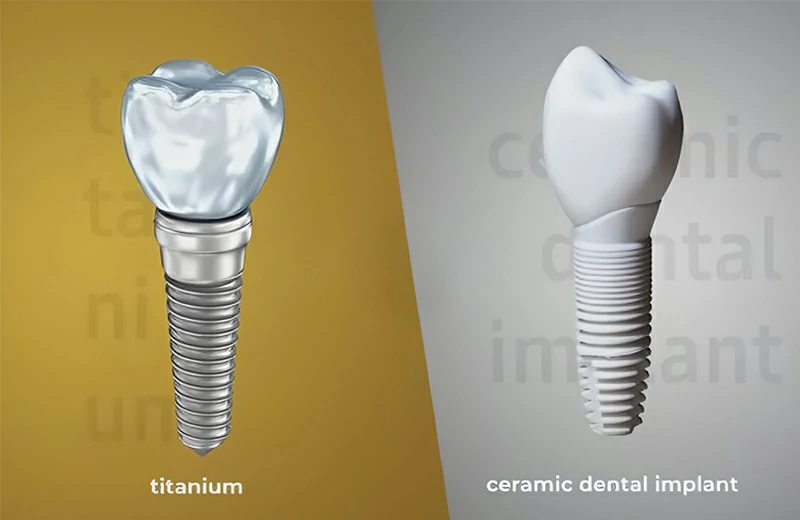 Choosing between titanium and zirconia (ceramic) implants