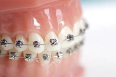 Deep Bite Correction Deep Bite Correction