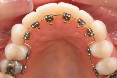 Lingual Orthodontics Lingual Orthodontics