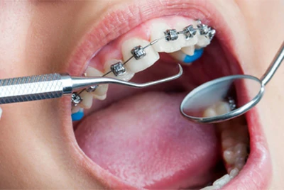 Orthodontic Treatments Orthodontic Treatments