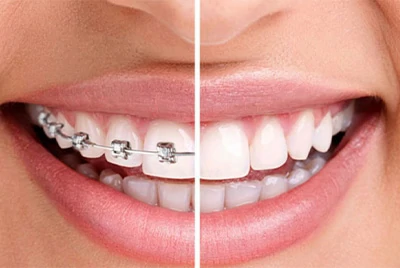 Orthodontic Treatments Orthodontic Treatments