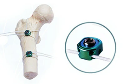 Orthopedic Fixation – Bone Cerclage & K-Wires