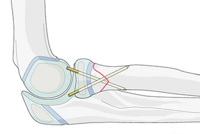 Orthopedic Fixation – Bone Cerclage & K-Wires