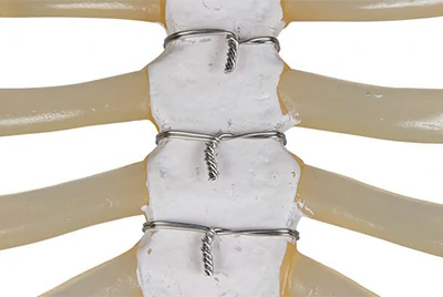 Sternal Closure Wire