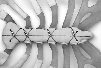 Sternal Closure Wire