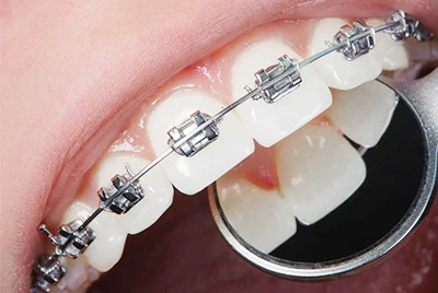 Dental Orthodontic Archwire