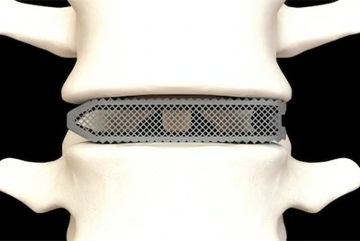 Medical|Soluções de implantes personalizadas de alta pureza