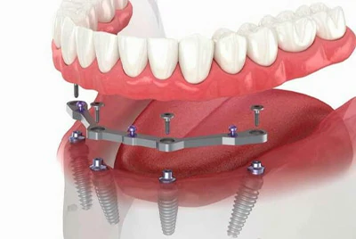 Tıbbi Cihazlar ve İmplantlar