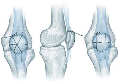 Patella-Cerclage (Fixation der Kniescheibenfraktur)