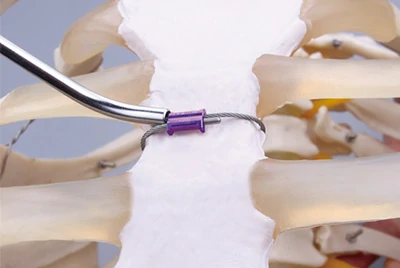 Fixierung des spinalen Spannungsbandes