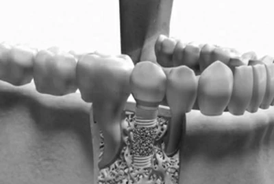 Tıbbi İmplantlar ve Kemik Onarımı