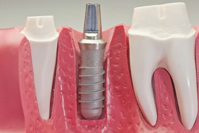 Grade 5 titanium surgical components