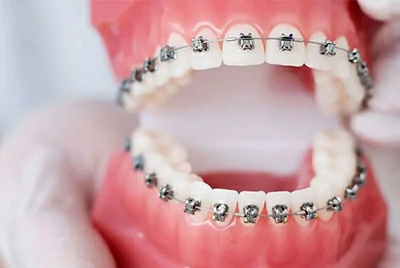 NiTi Orthodontic Archwires: Comfortable, Efficient & Customizable